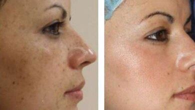 Receita Caseira para acabar com Manchas no Rosto, Rugas e Melasmas