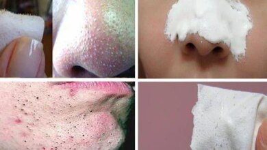 Tire os cravos do seu rosto em apenas 15 minutos