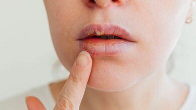 remédio caseiro para herpes labial