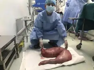 1497368072 165 cirurgiao removeu isso de um homem que estava constipado ha anos