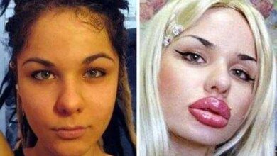 9 cirurgias plásticas que mais deram errado