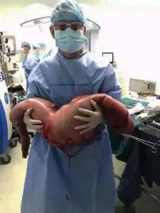1497368072 783 cirurgiao removeu isso de um homem que estava constipado ha anos