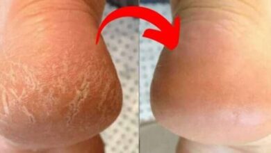 Livre-se dos pés rachados com 4 receitas caseiras INCRÍVEIS