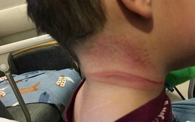 Mãe posta foto e faz alerta aos pais após filho quase se enforcar em acidente doméstico