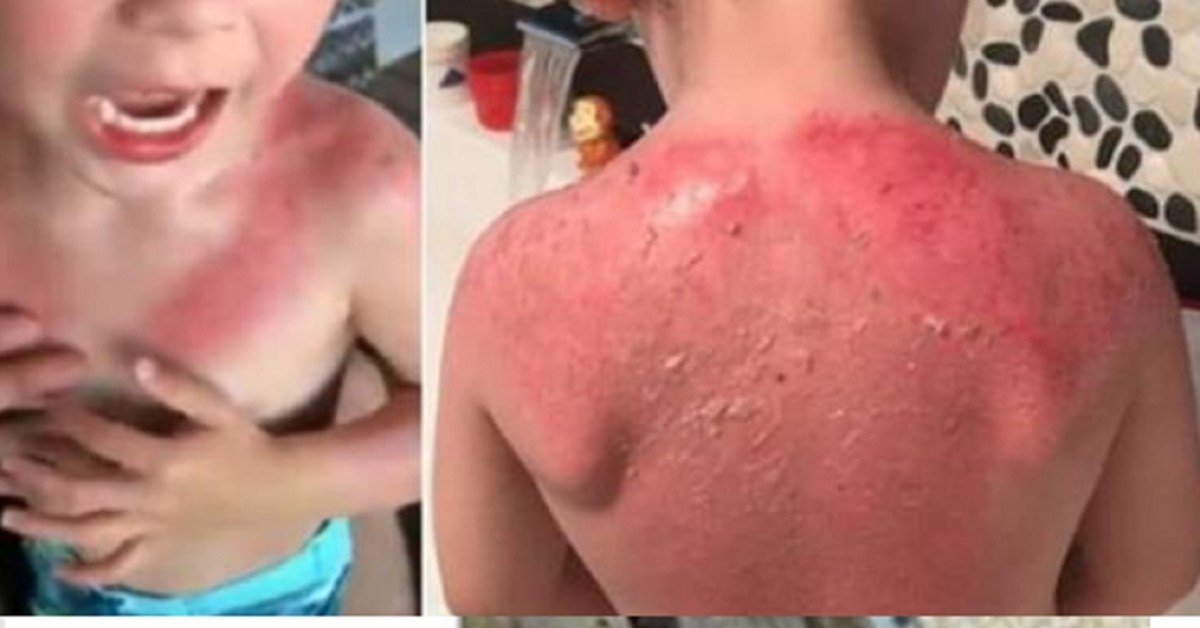 Pai faz alerta sobre o bronzeador da Peppa Pig que