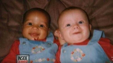 Primeiras gêmeas do mundo com cores de pele diferentes já são adultas: vejam como estão hoje!