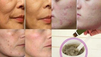 Receita caseira que elimina espinhas, cravos e rugas