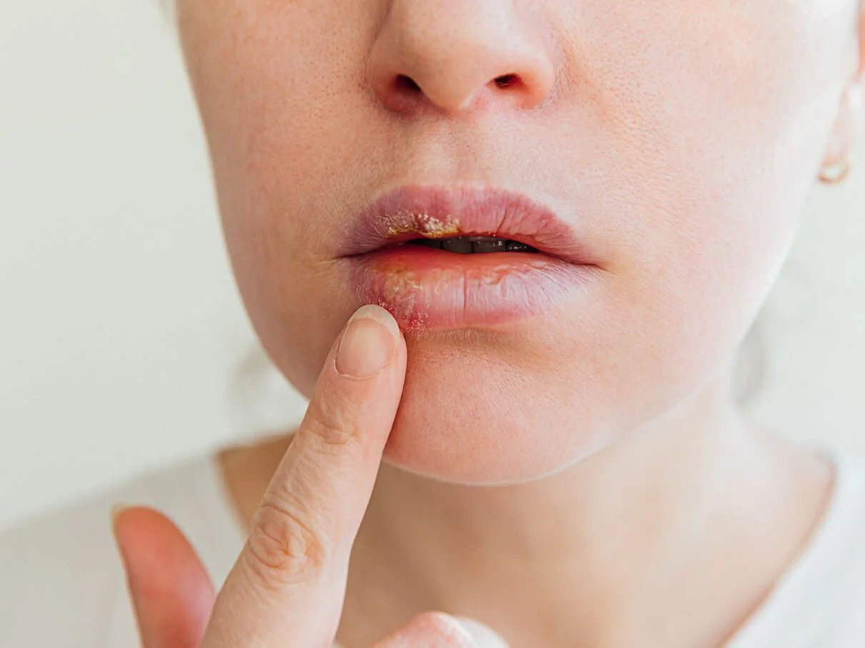 remédio caseiro para herpes labial