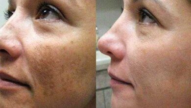 Remova suas manchas,rugas e melasma com 3 receitas top