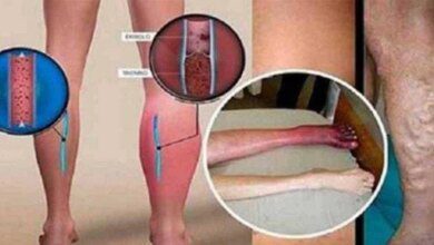 Saiba como evitar uma trombose venosa profunda! Veja os sintomas e vigie o seu corpo.