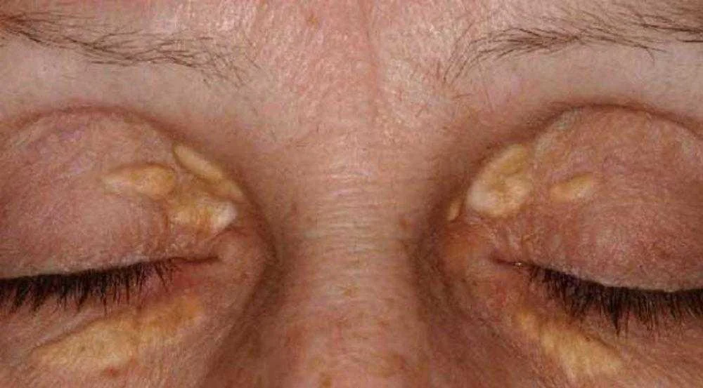 Se aparecer isto perto dos seus olhos, corra já para seu médico antes que seja tarde demais