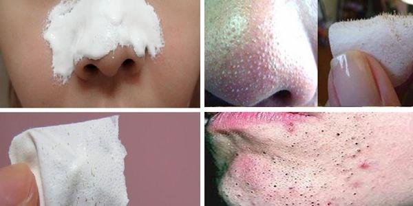 Tire os cravos do seu rosto em apenas 15 minutos